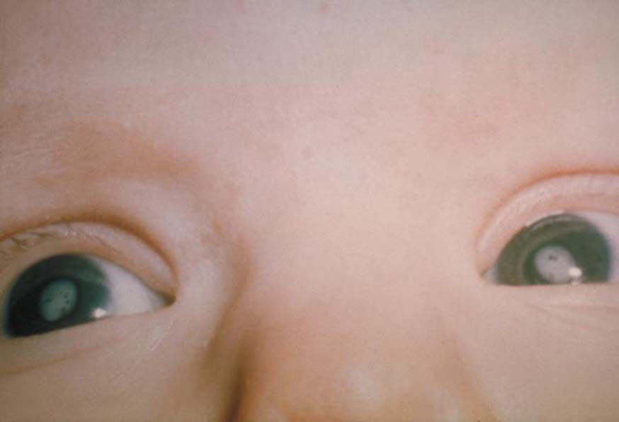 Cataracts_due_to_Congenital_Rubella_Syndrome