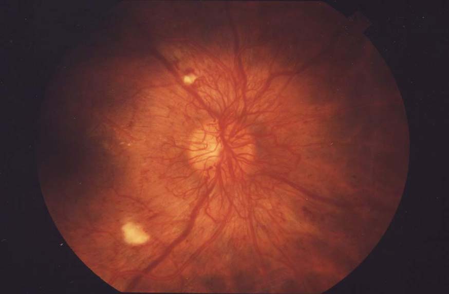 Diabetic-retinopathy-is-usually-asymptomatic-until-advanced-stages